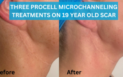 A 19-Year-Old Surgical Scar Transformed: How Microchanneling Is Changing the Approach to Scar Revision