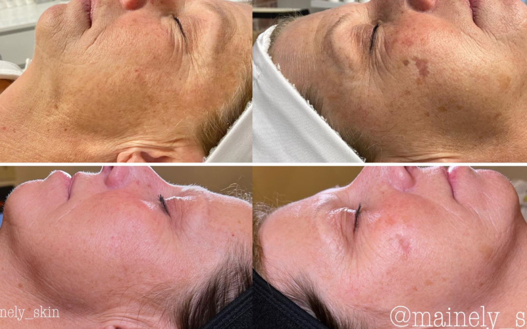 How to Treat Sun Damaged Skin