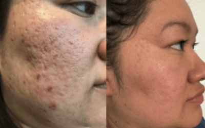 The Science of Skin Recovery: Treating Acne Scars Through Inflammation Control and Regenerative Therapies
